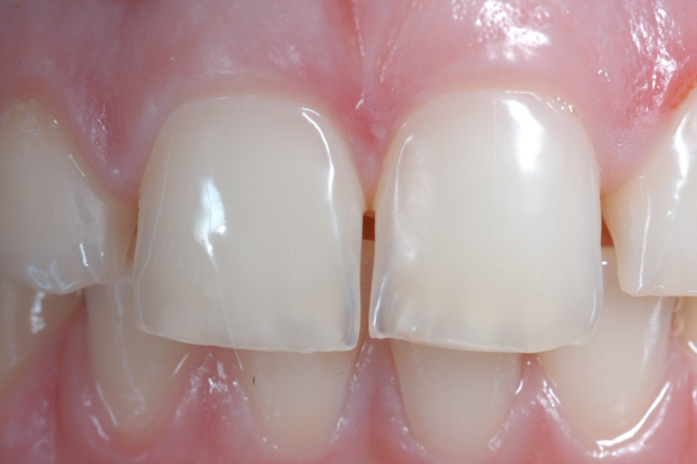 Health Professionals - Erosive Toothwear